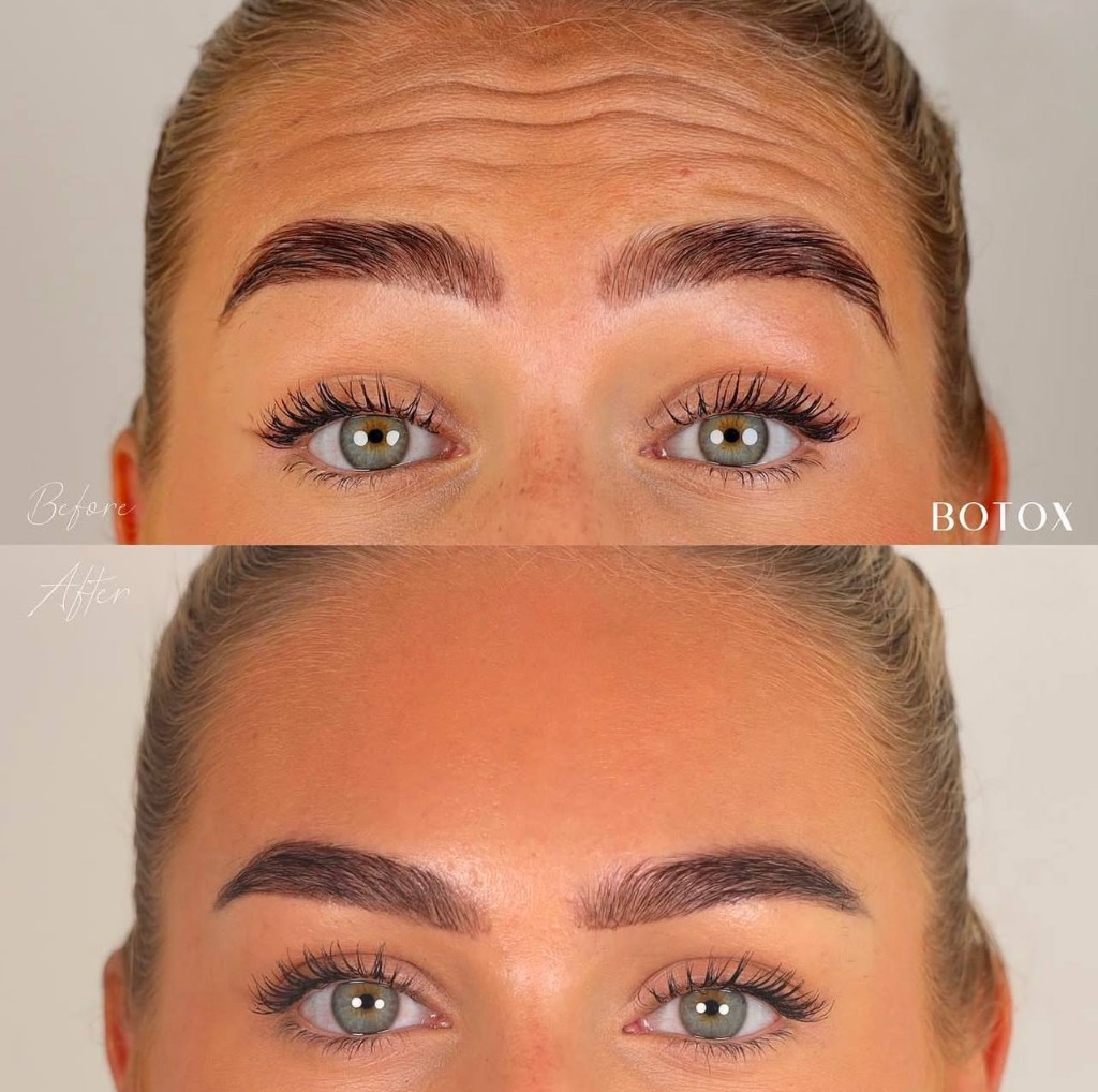 Botox Before/After