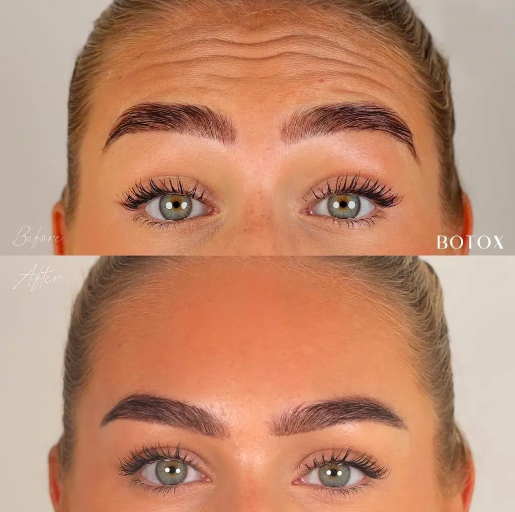 Botox before & after