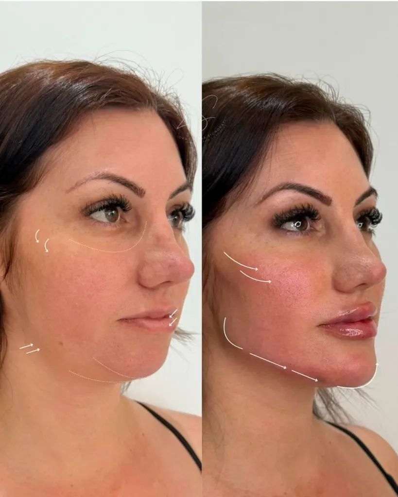 Facial Lift before & after