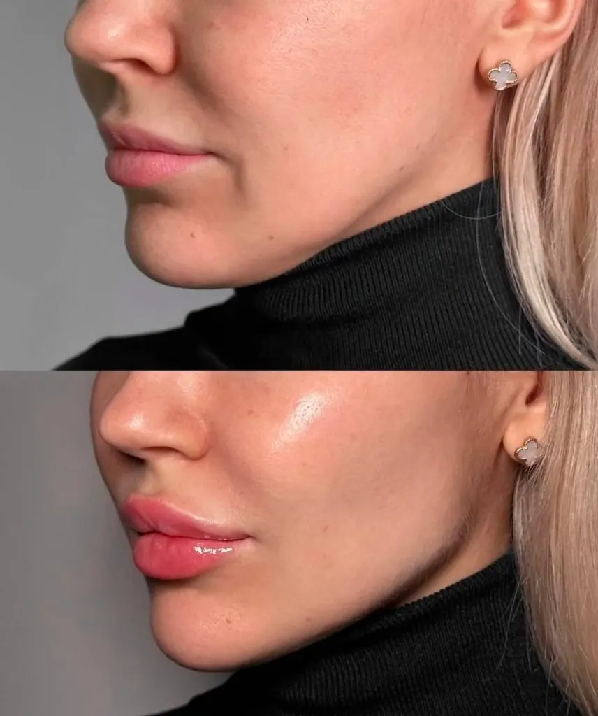 Lip Sculpting before & after
