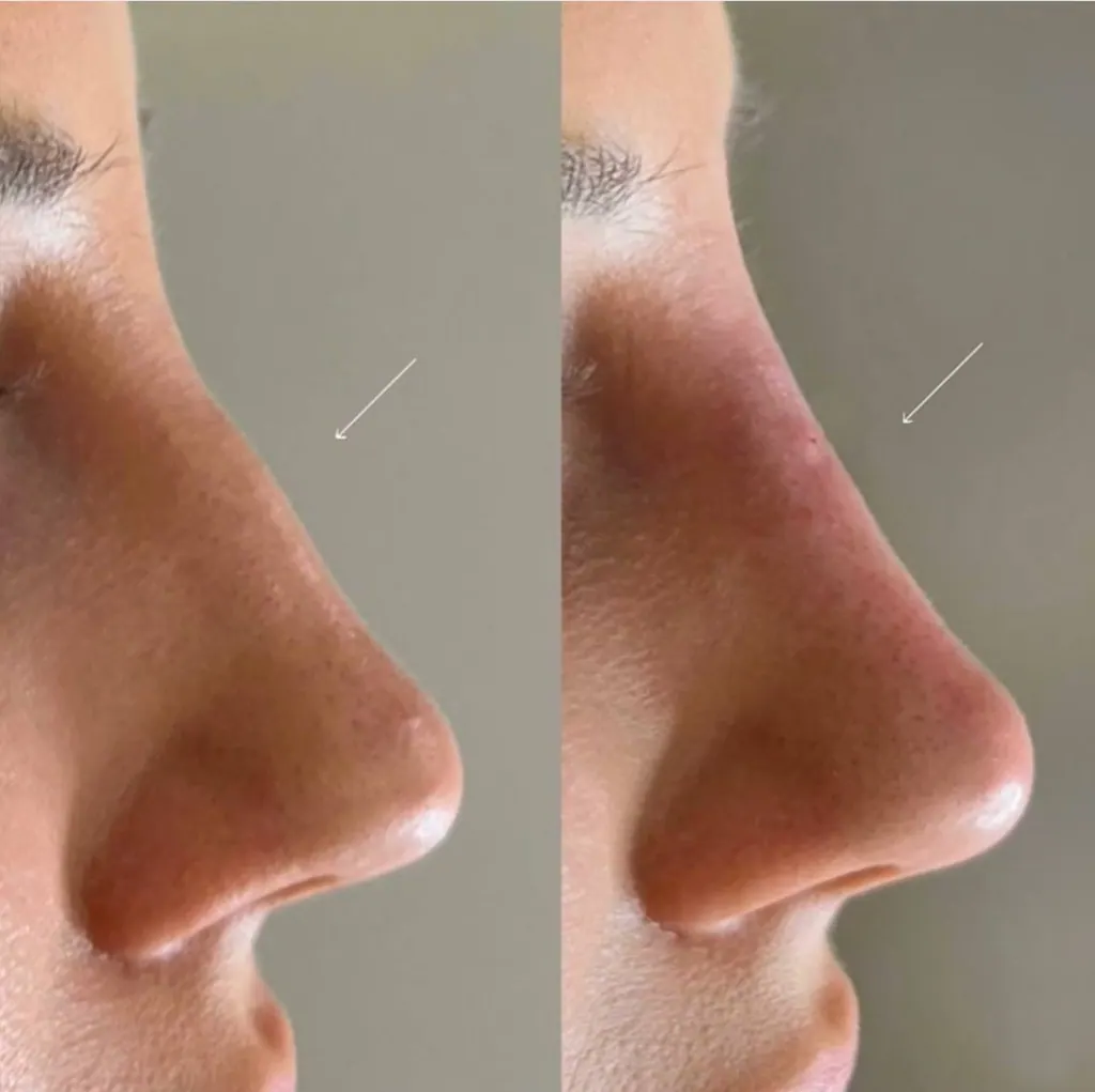 Nose Contour before & after