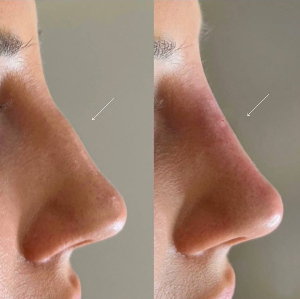 Nose Contour Before/After